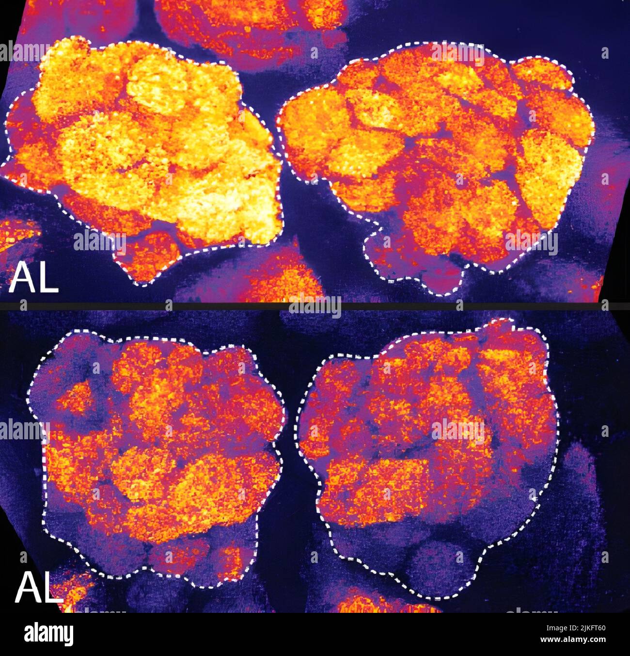Inoltre, il cervello di una mosca affamata diventa arancione assonnato a causa di Bruchpilot, una proteina di comunicazione tra le cellule cerebrali. Queste aree di colore arancione chiaro del cervello sono associate all'apprendimento. In fondo, una mosca ben riposata mostra livelli inferiori di Bruchpilot, che potrebbe rendere la mosca pronta ad imparare dopo una buona notte di riposo. Queste immagini illustrano i risultati di uno studio dell'aprile 2009 che mostra che il sonno riduce i livelli proteici, suggerendo che tale downscaling e quot resetta il cervello ai livelli normali di attività sinaptica e lo rende pronto per imparare dopo una notte riposante. Foto Stock
