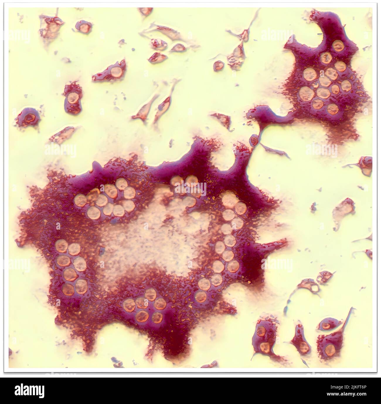 Gli scienziati NIAMS hanno trovato la prova che un elevato numero di osteoclasti, un tipo di cellula che si rompe l'osso, può contribuire alla perdita dell'osso in persone con spondiloartrite. Gli osteoclasti, come quello mostrato qui al centro, contengono nuclei multipli (cerchi leggeri) perché sono formati per fusione di cellule precursori. Foto Stock