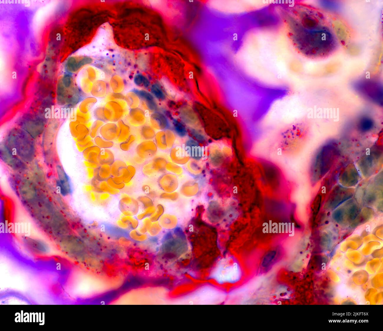 Durante il normale sviluppo osseo e la guarigione delle fratture, la cartilagine si trasforma in osso. Gli osteoclasti, un tipo di cellula specializzata, mangiano cartilagine, forniscono passaggio per vasi sanguigni, midollo ed altre cellule ossee. In questa immagine della cartilagine (viola e bianca) di un giovane femore di topo, gli osteoclasti (rossi) circondano un vaso sanguigno pieno di globuli rossi (gialli). A differenza degli osteoclasti normali, le cellule qui presenti hanno un solo nucleo a causa dell'assenza di un gene coinvolto nello sviluppo degli osteoclasti. Foto Stock