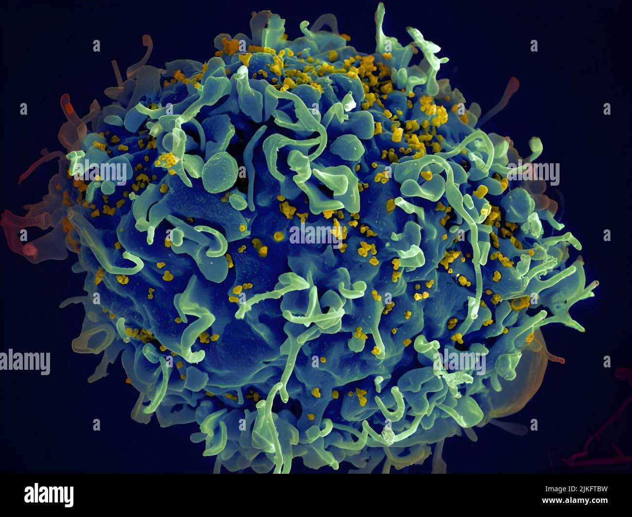 Questa cellula T umana (blu) è attaccata dall'HIV (giallo), il virus che causa l'AIDS. Il virus colpisce le cellule T, che svolgono un ruolo vitale nella risposta immunitaria del corpo contro invasori come batteri e virus. Foto Stock