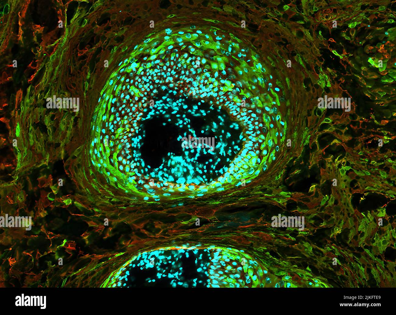 Questa immagine mostra l'espressione di cheratina 5 (rossa) e cheratina 1 (verde) nei tumori della pelle. Le cheratine sono proteine strutturali fibrose che si trovano in strutture epiteliali, come pelle, capelli e unghie. Formano filamenti che danno forza e tenacità alle strutture. Le cheratine sono spesso usate per aiutare nella diagnosi di carcinoma a cellule squamose, una forma di cancro della pelle. Foto Stock