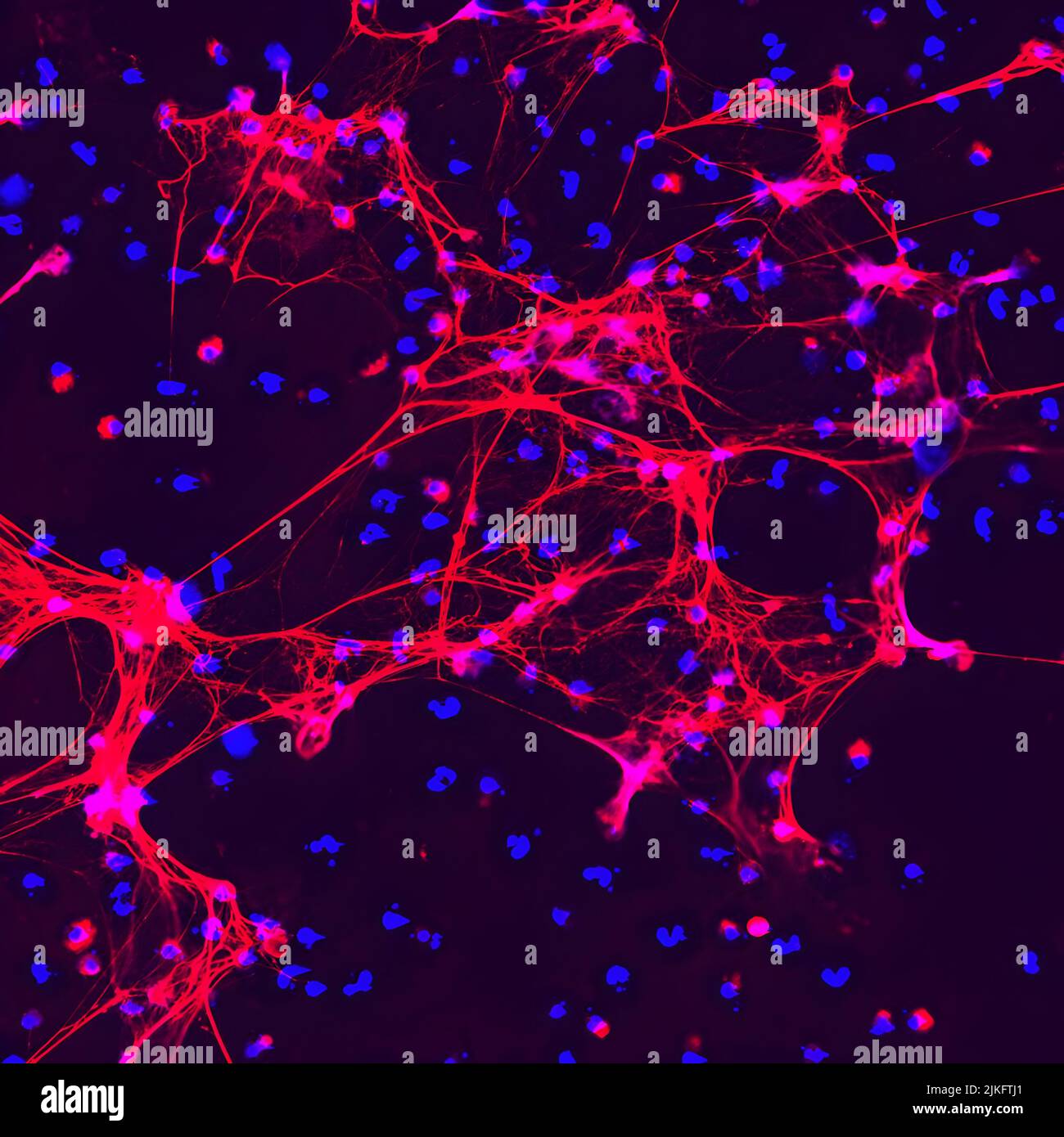 Le trappole extracellulari dei neutrofili (reti) sono strutture web-simili che le cellule immunitarie chiamate neutrofili usano per intrappolare e uccidere microbi come batteri o funghi. Le reti sono mostrate come DNA (blu) formando un complesso con elastasi proteica del granulo dei neutrofili (rosso). Normalmente, le reti vengono rilasciate in risposta a patogeni invasivi, ma sono state anche associate a malattie autoimmuni. Per questa immagine, le reti sono state indotte dal levamisolo, un farmaco che può promuovere l'autoimmunità. Foto Stock