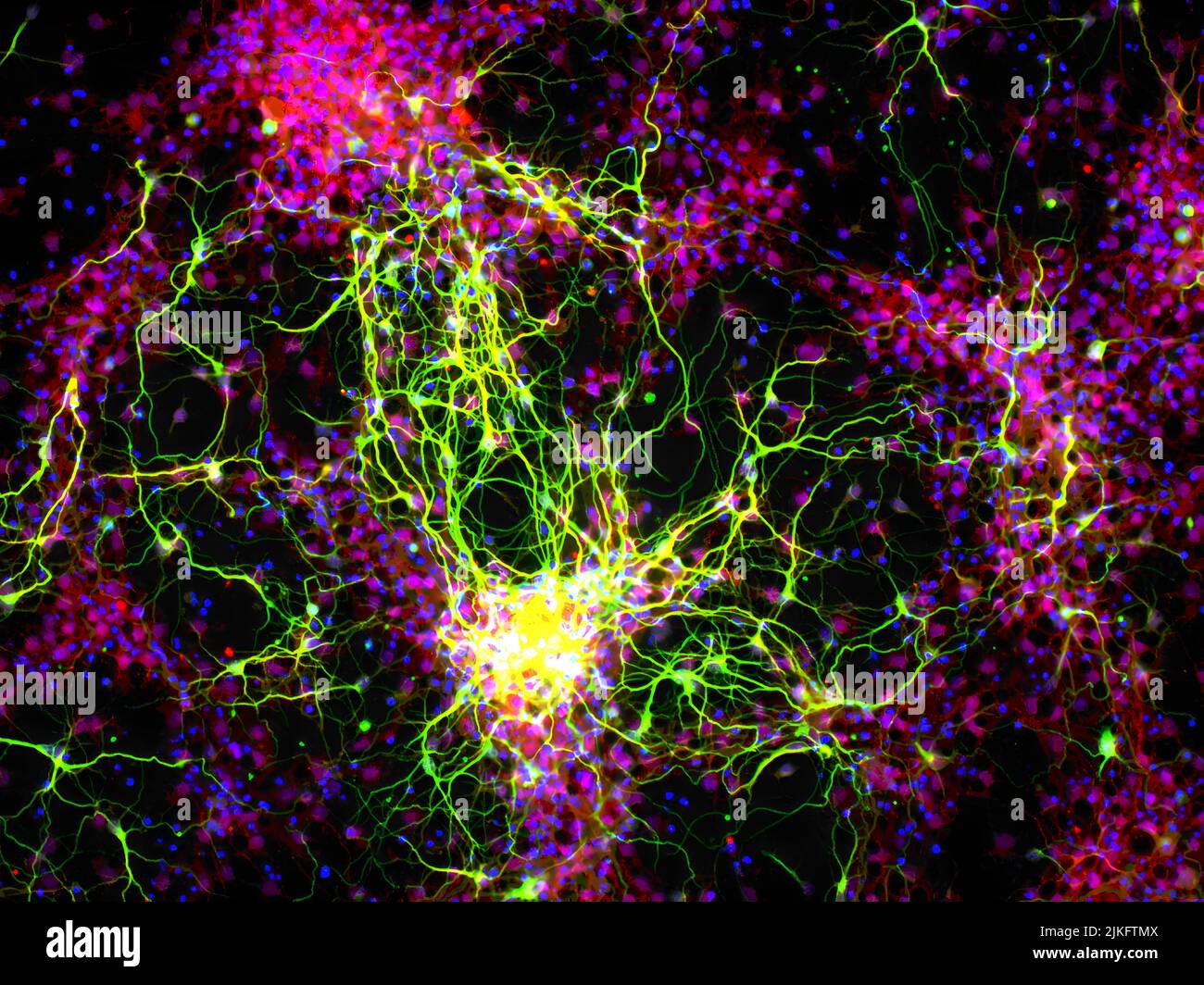 Le cellule del ganglio retinico sono neuroni che trasmettono informazioni sulla luce dall'occhio al cervello attraverso una struttura chiamata nervo ottico. Qui, nuovi neuroni (verdi) e le loro cellule di supporto, chiamati astrociti (rossi), sono stati creati in una piastra di Petri da cellule staminali. Facendo cellule di ganglio retinico e astrociti da cellule staminali potrebbe un giorno aiutare i medici a ricalcare i nervi ottici danneggiati dal glaucoma. Foto Stock