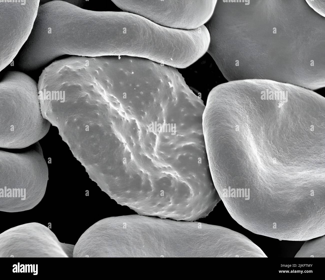 Micrografia elettronica di globuli rossi infettati con Plasmodium falciparum, il parassita responsabile della malaria negli esseri umani. Durante il suo sviluppo, il parassita forma proiezioni chiamate e quot Foto Stock
