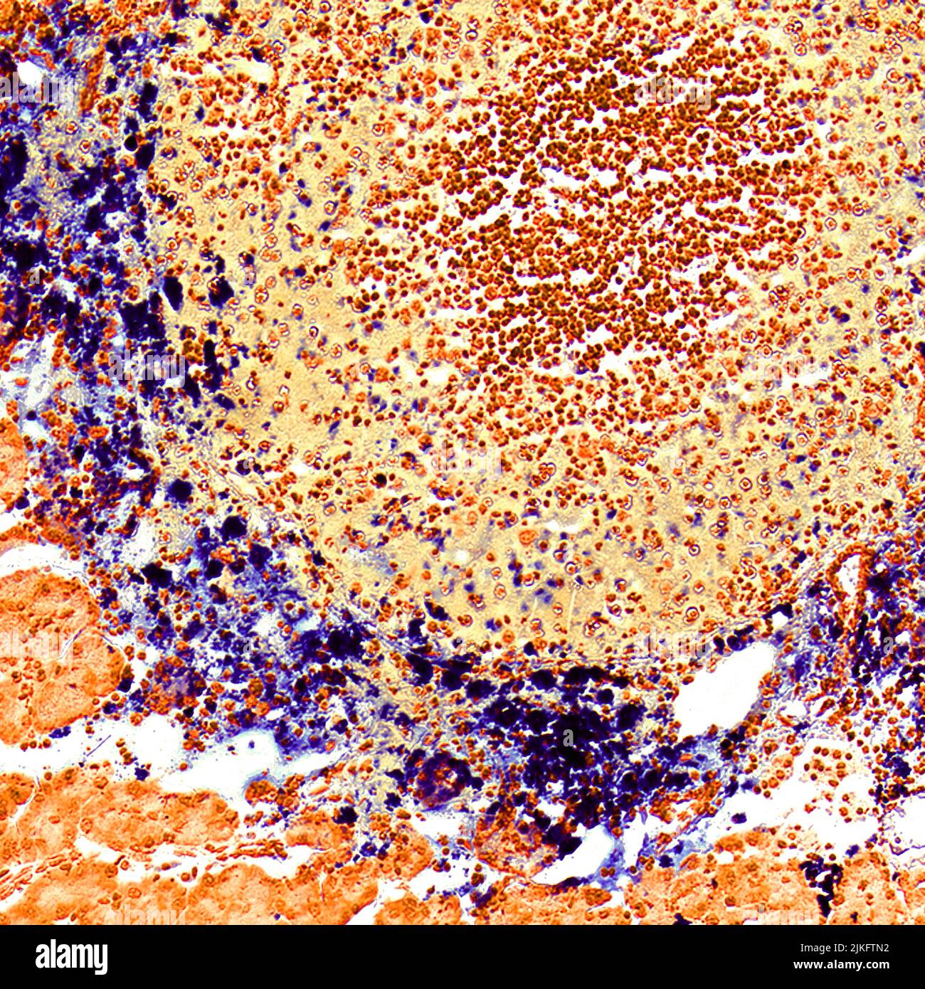 Gli investigatori del Cancer Nanotechnology Platform Partnership (CNPP) presso l'Emory University hanno sviluppato nanoparticelle di ossido di ferro magnetico mirate al tumore per la terapia del cancro pancreatico guidata da immagini. Le nanoparticelle erogano agenti terapeutici nei tumori del cancro pancreatico e producono segnali che possono essere rintracciati mediante risonanza magnetica (MRI). Questa immagine in microscopia di una sezione tumorale (ottenuta da un modello di tumore di topo) mostra le nanoparticelle colorate in blu che si accumulano selettivamente nell'area periferica del tumore e quindi penetrano nelle cellule tumorali. Foto Stock