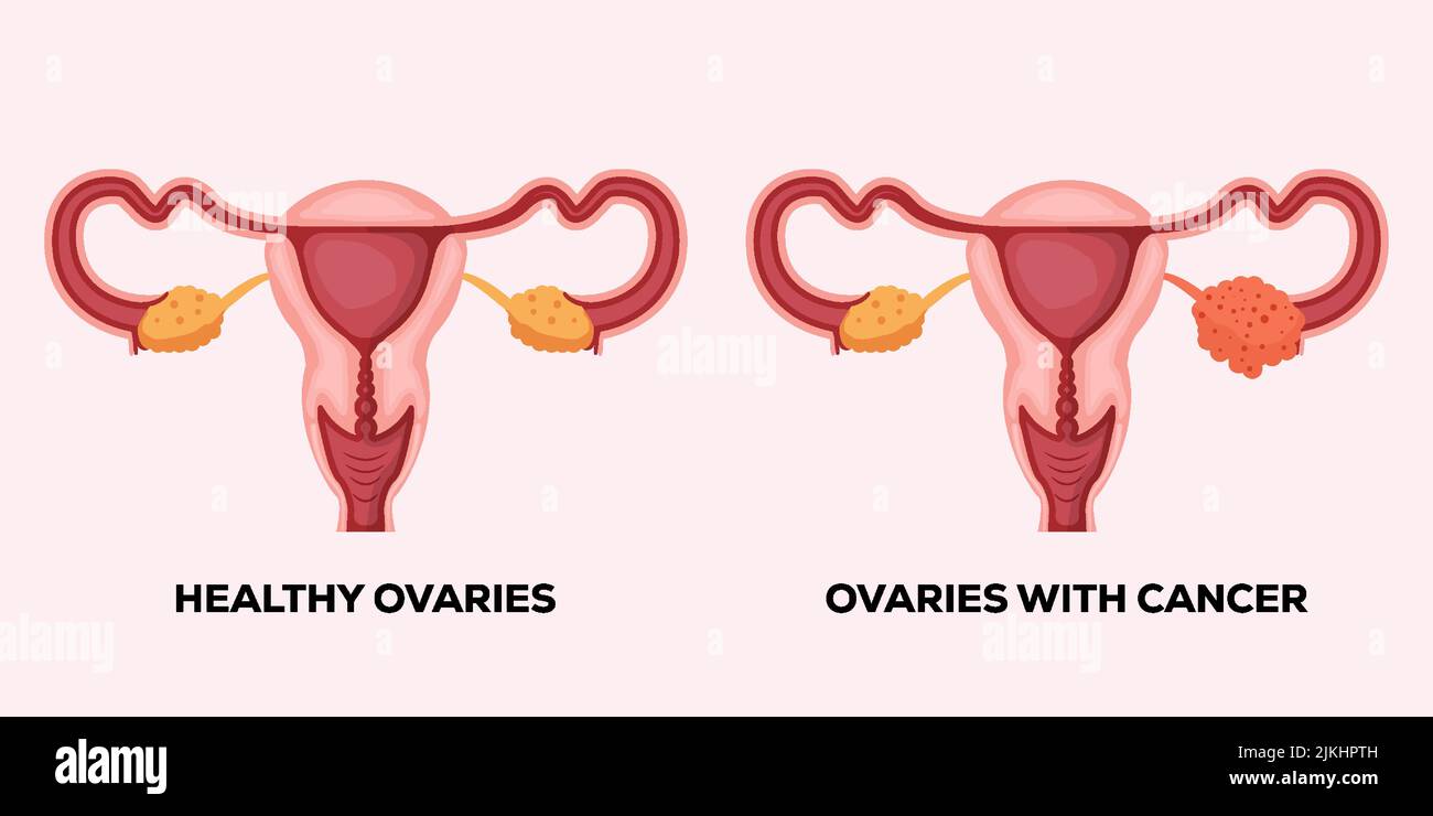 illustrazione di ovaie sane, e ovaie con cancro Illustrazione Vettoriale