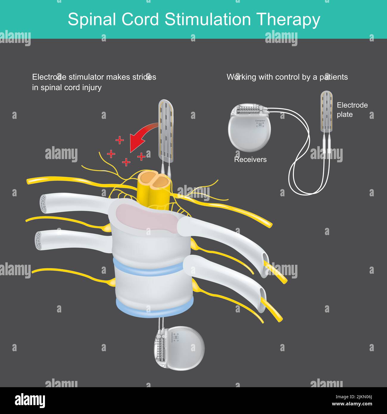 Terapia di stimolazione del midollo spinale. Un impianto elettronico per l'uso del corpo per la terapia del dolore al collo e alla schiena. Illustrazione Vettoriale