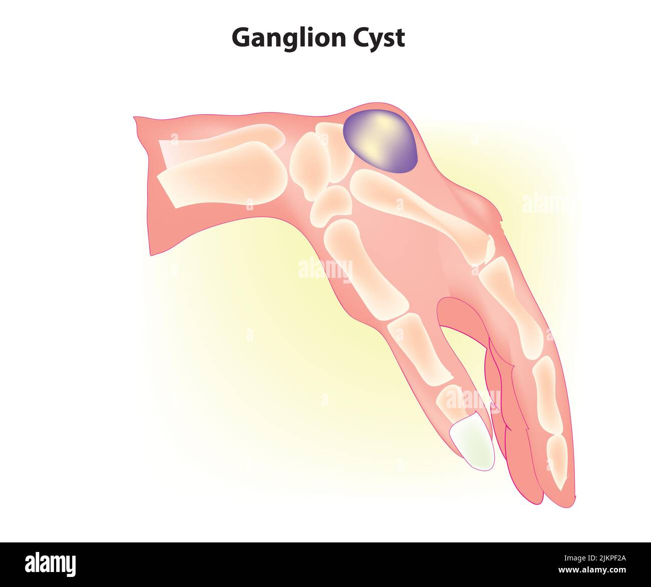 Cisti ganglion in mano Foto Stock