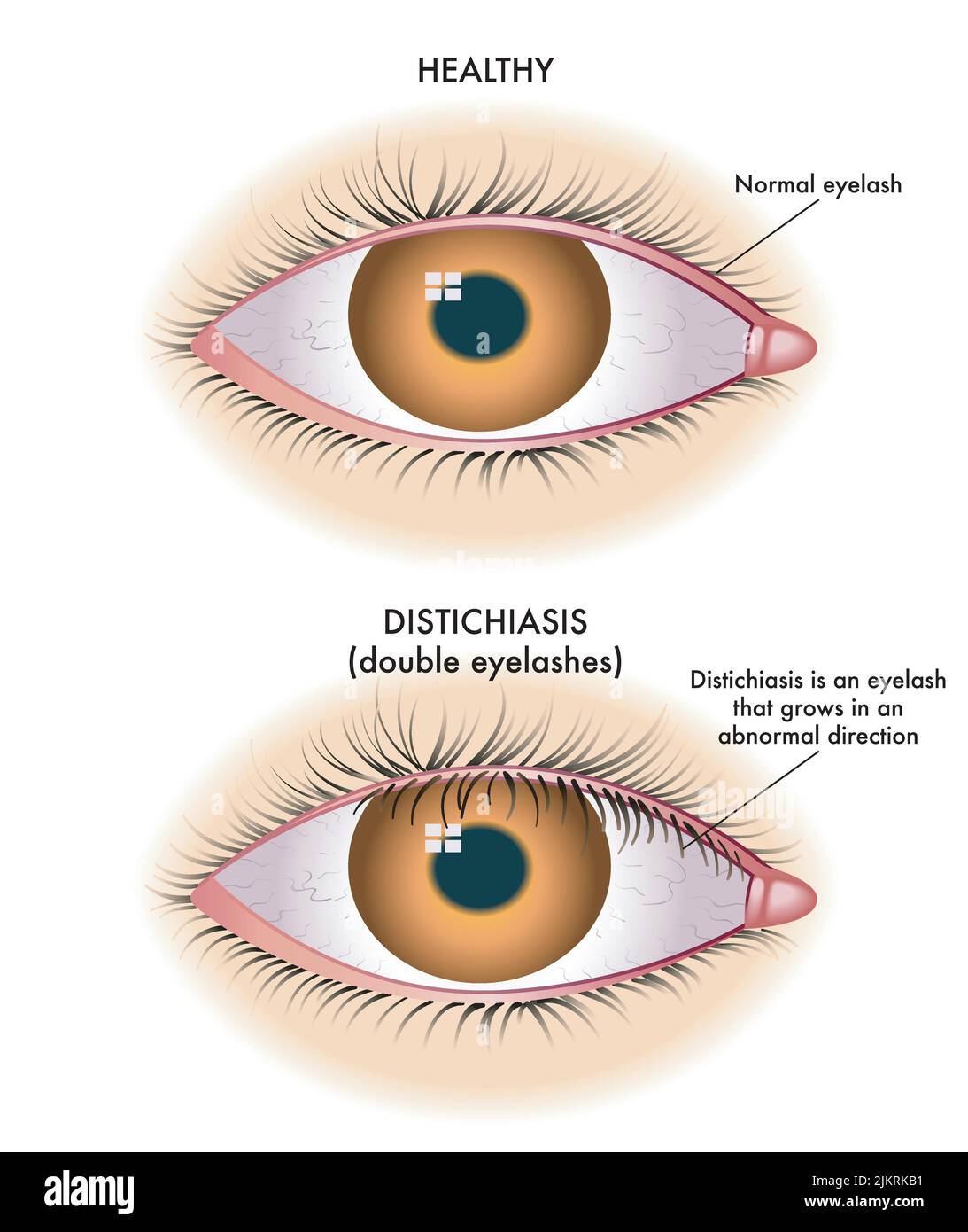 L'illustrazione medica mostra il confronto tra un occhio normale e uno affetto da distichiasi. Illustrazione Vettoriale