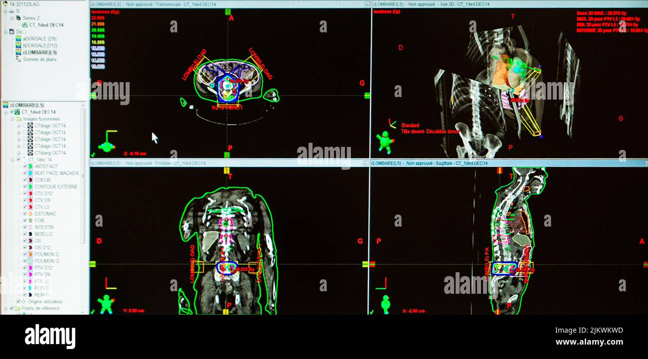 Trattamento delle metastasi ossee mediante radioterapia. Foto Stock