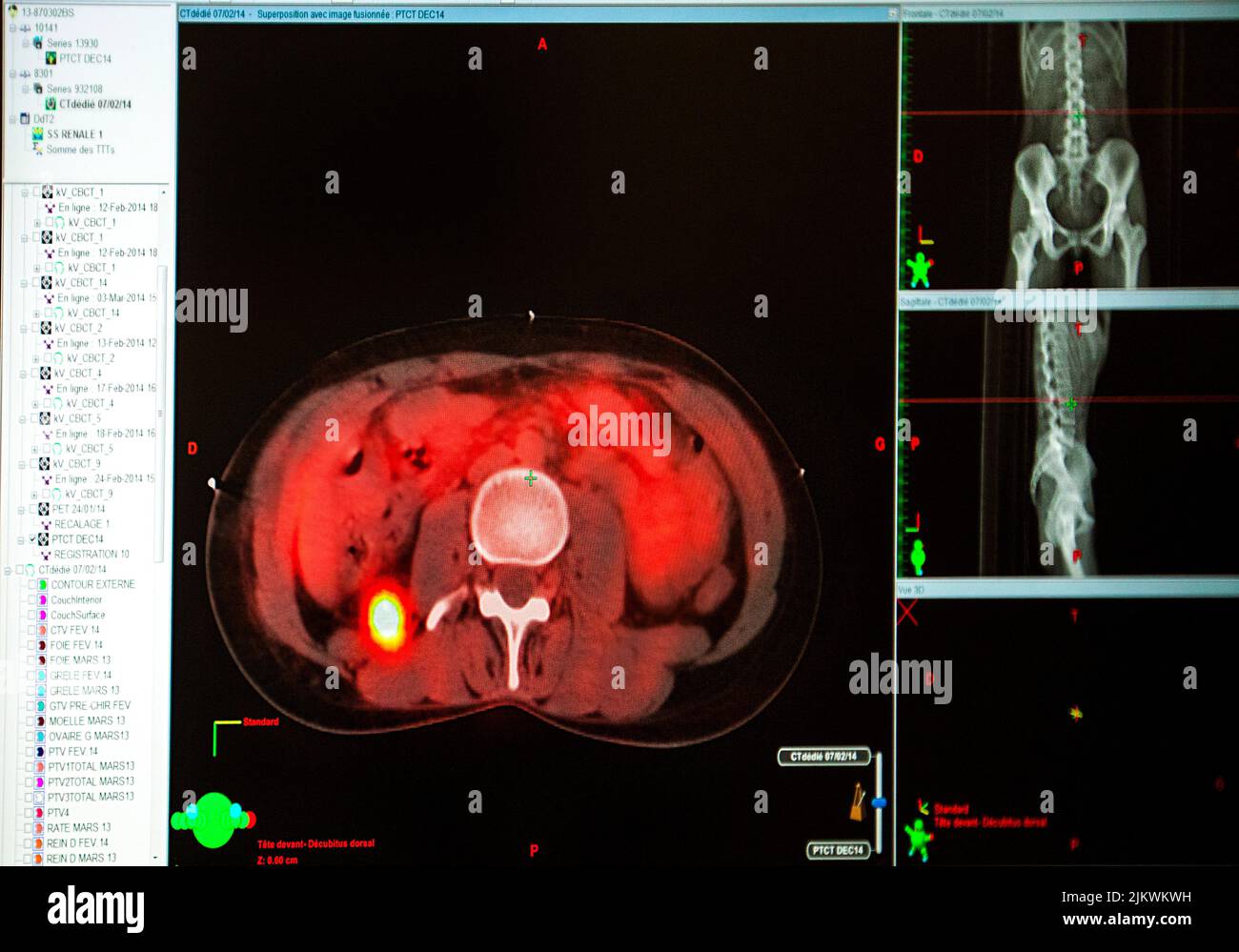 Trattamento di un tumore surrenale mediante radioterapia in oncologia. Foto Stock