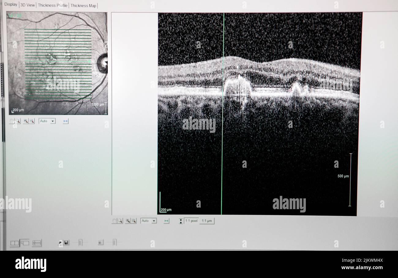 Tomografia a coerenza ottica (Oct) che mostra gli inizi della degenerazione maculare. Foto Stock