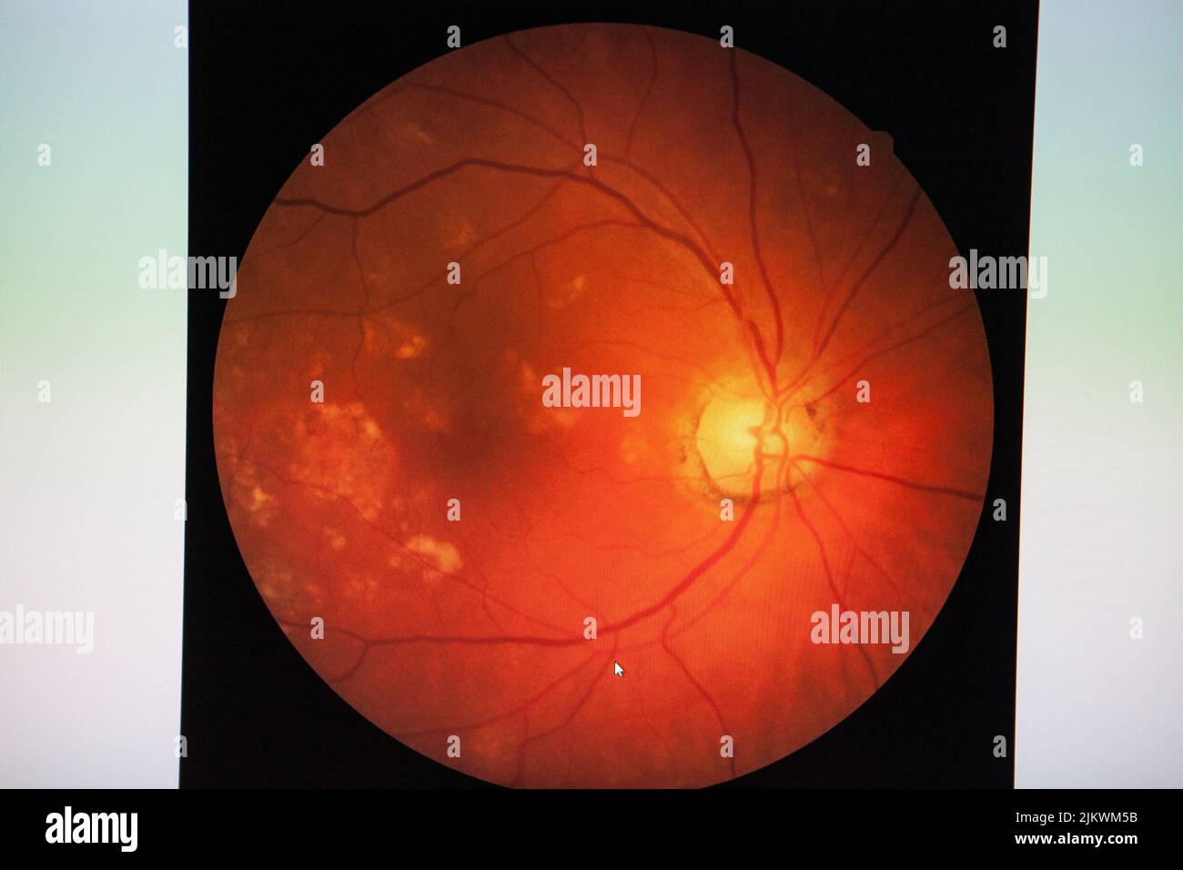 Fundus: Esame di routine stabilito da un oftalmoscopio per controllare la salute dell'occhio. Foto Stock