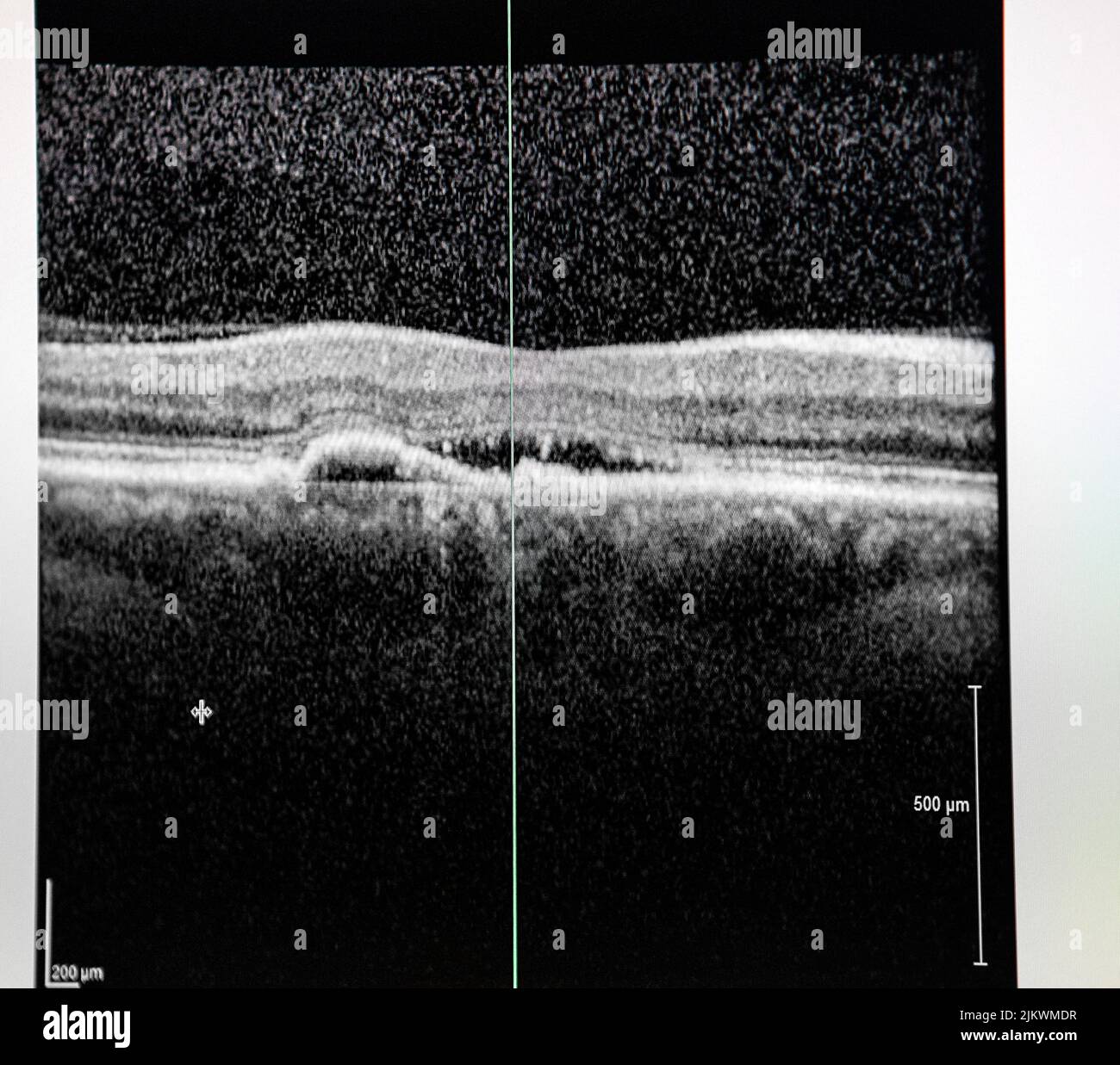 Tomografia a coerenza ottica (Oct) di un paziente con edema maculare. Foto Stock