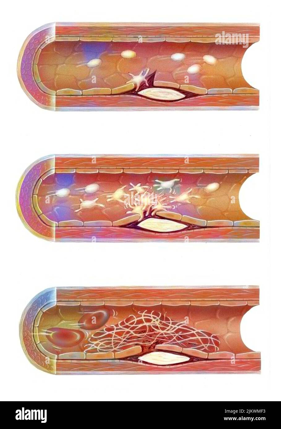 Ateroma: Lesione della superficie interna delle arterie causata da un deposito di colesterolo. Foto Stock