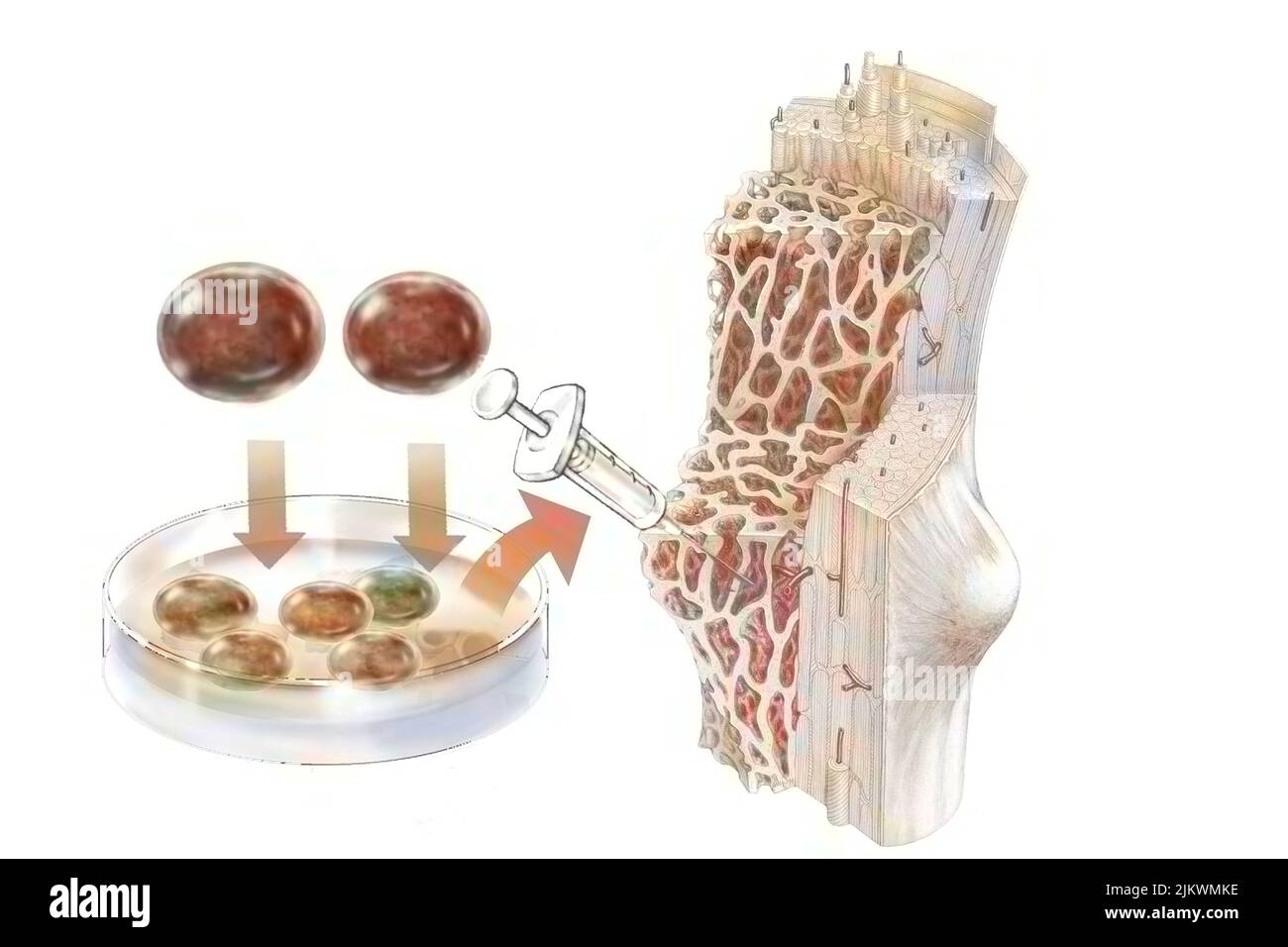 Trapianto di cellule staminali ematopoietiche somministrate per colonizzare il midollo osseo. Foto Stock