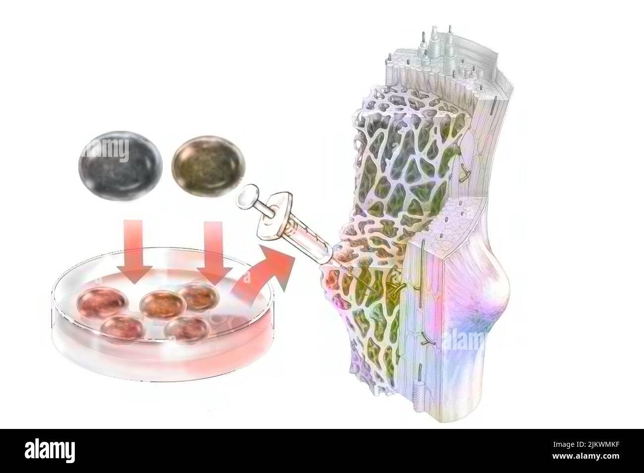 Trapianto di cellule staminali ematopoietiche somministrate per colonizzare il midollo osseo. Foto Stock