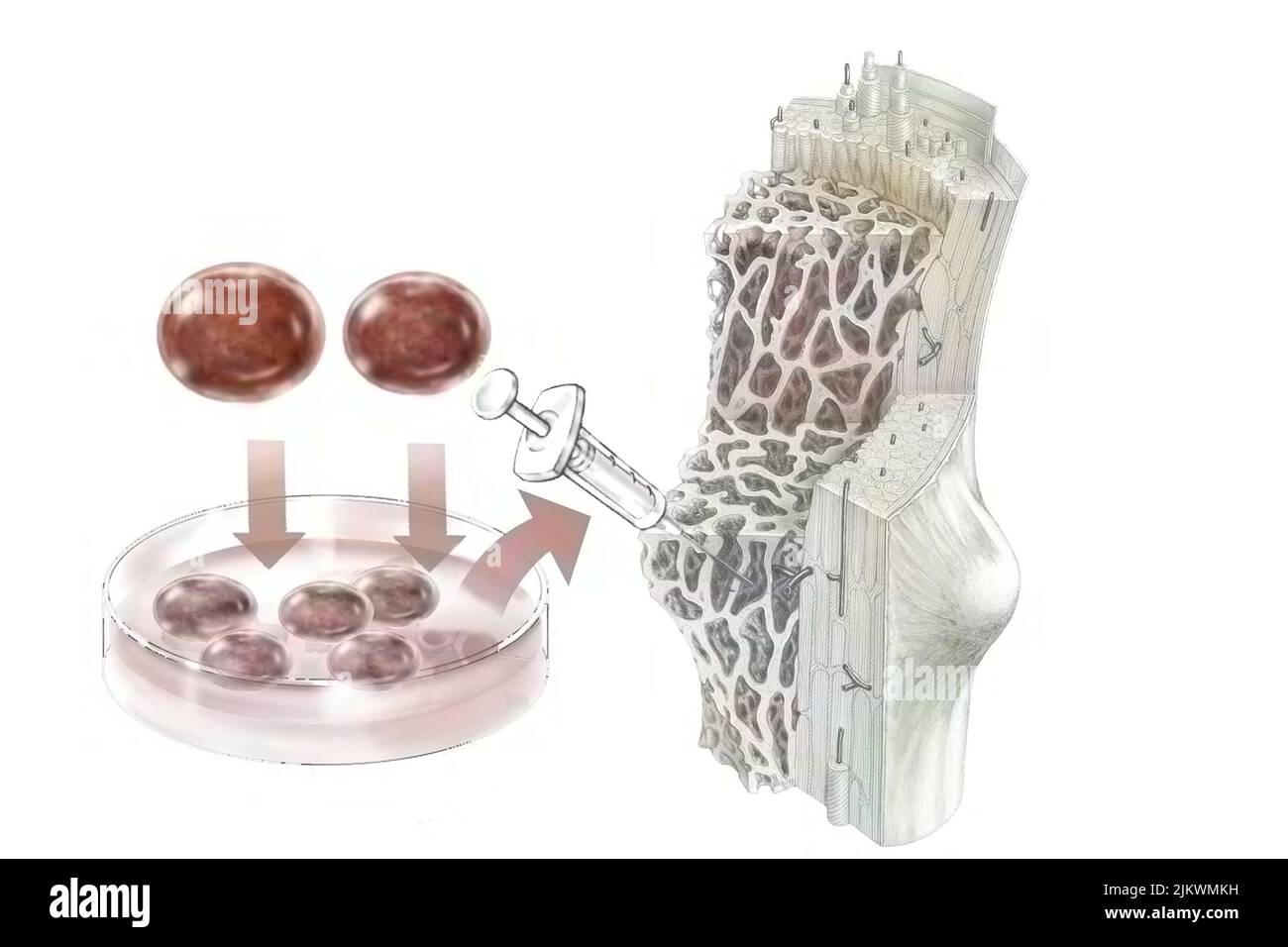 Trapianto di cellule staminali ematopoietiche somministrate per colonizzare il midollo osseo. Foto Stock