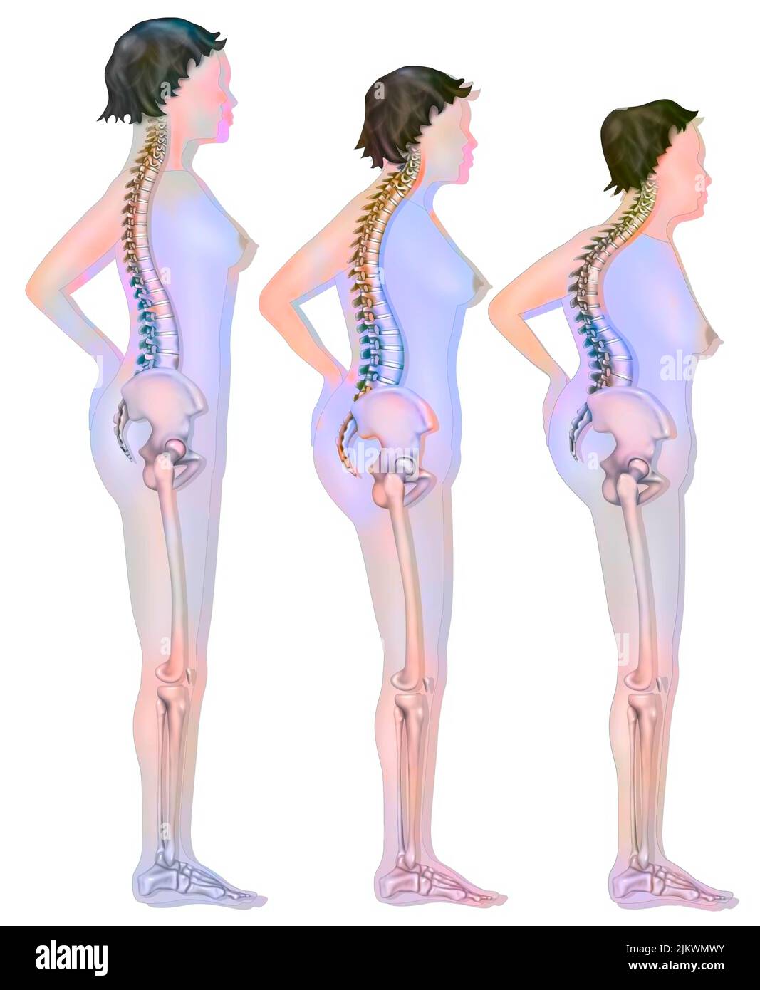 Modifica della silhouette legata all'osteoporosi (compressione vertebrale). Foto Stock