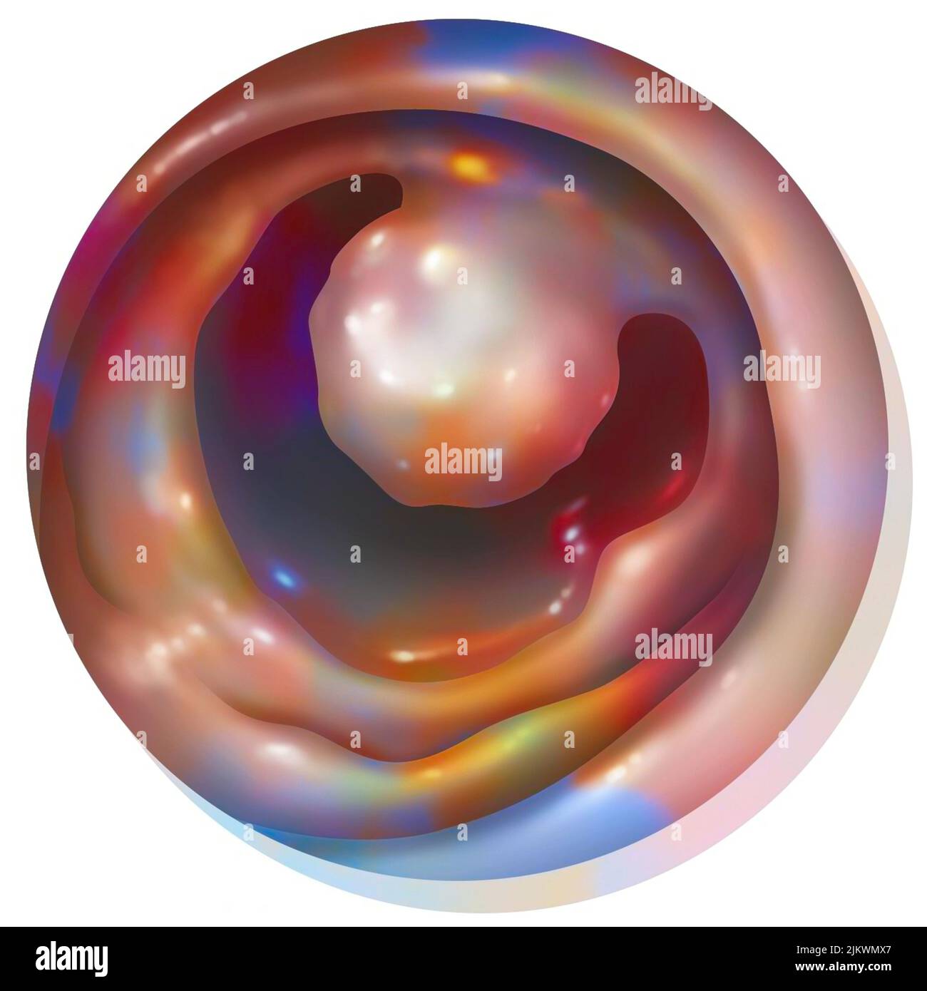 Anatomia del colon: Primo piano di un polipo del colon. Foto Stock