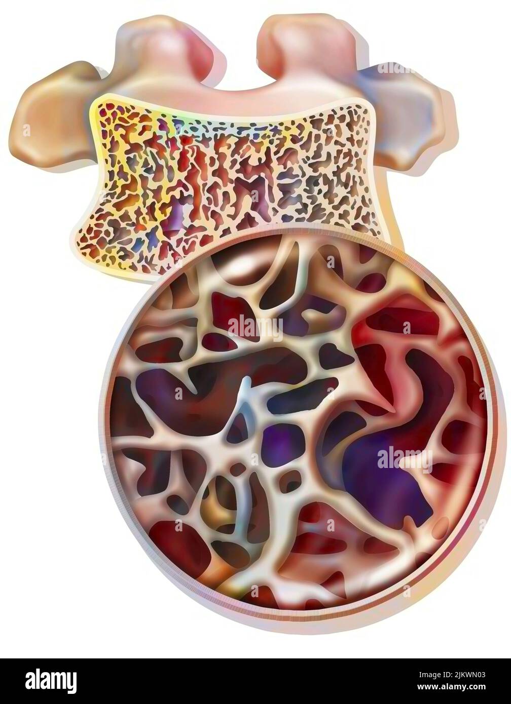 Vertebre dorsali con osteoporosi con tessuto cannelloso parzialmente distrutto. Foto Stock