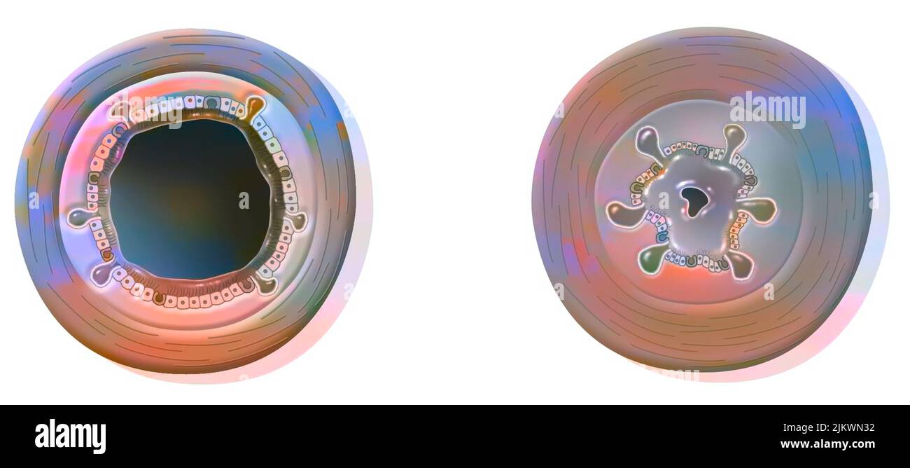 Confronto tra bronchi sani e bronchite (bronchite acuta). Foto Stock