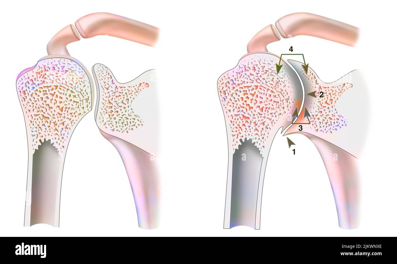 Caviglia sana con artropatia emofilica nel taglio frontale. Foto Stock