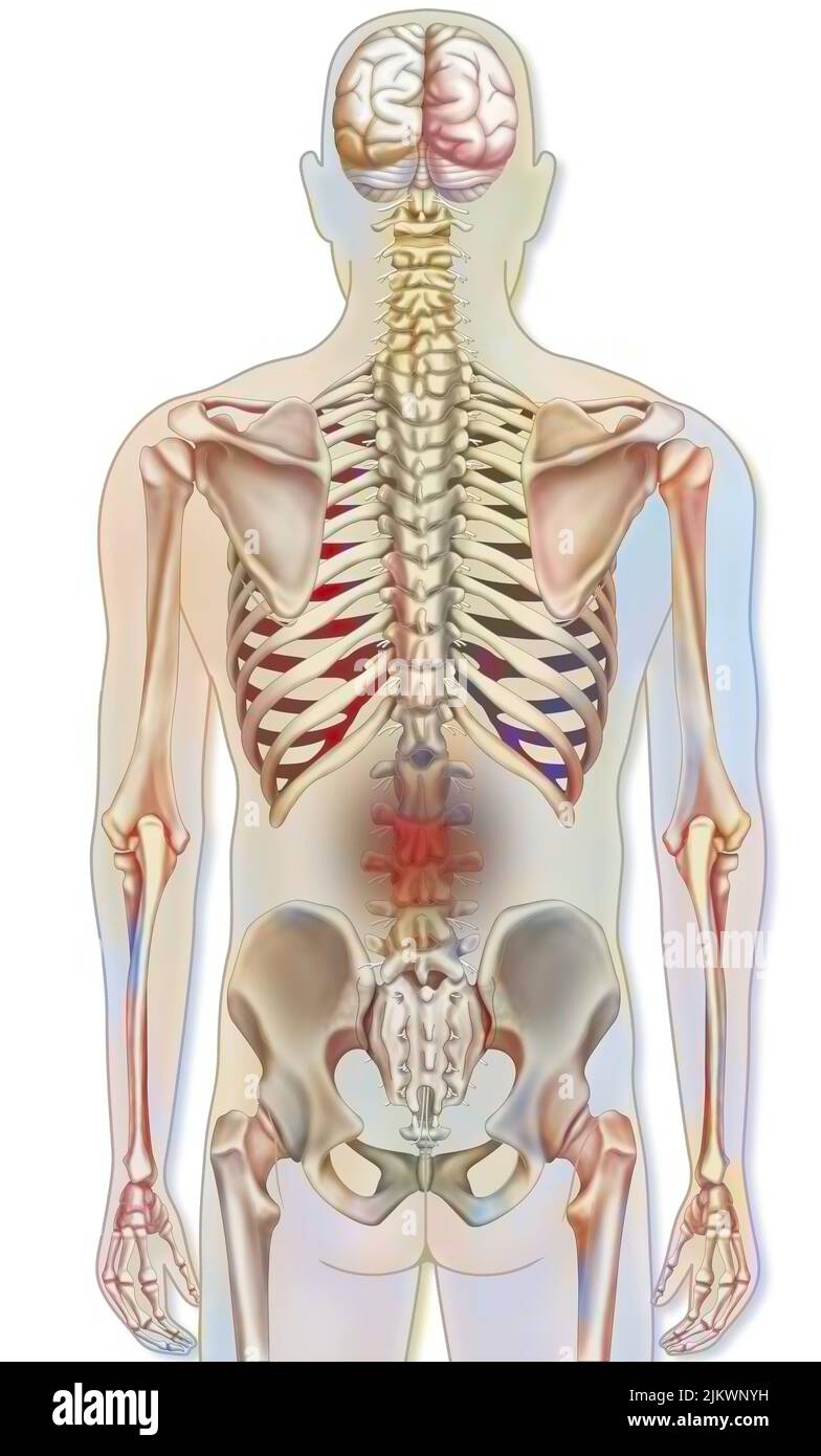 Sistema osseo: Scheletro umano con rappresentazioni di dolore lombare. Foto Stock