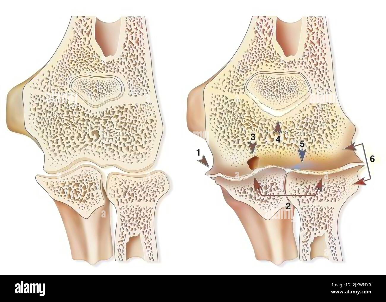 Confronto tra un gomito sano e un'artropatia emofilica (emartrosi). Foto Stock