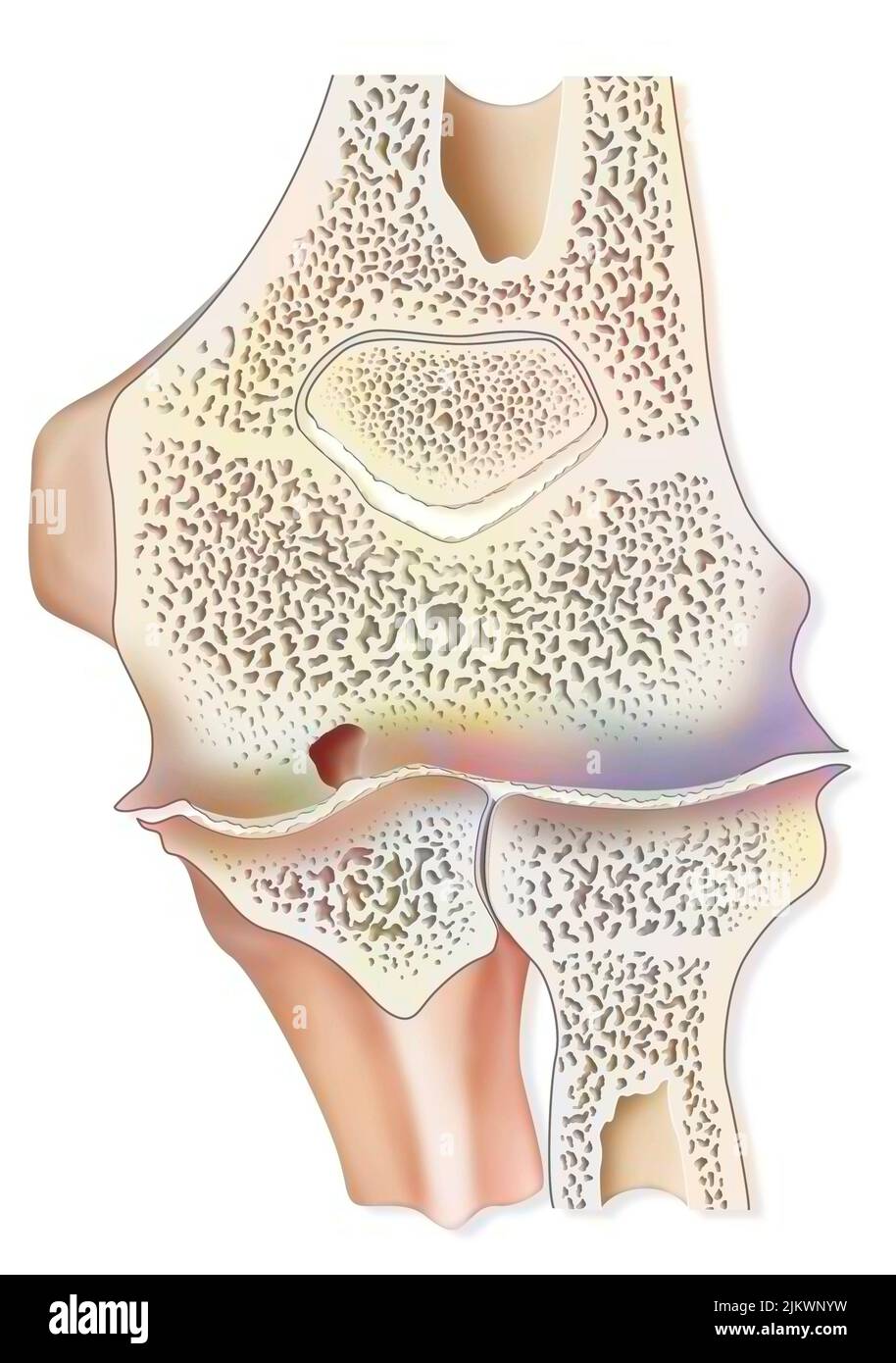 Artropatia emofilica del gomito (emartrosi) nella sezione sagittale. Foto Stock