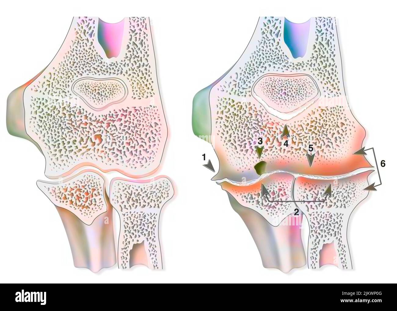 Confronto tra un gomito sano e un'artropatia emofilica (emartrosi). Foto Stock