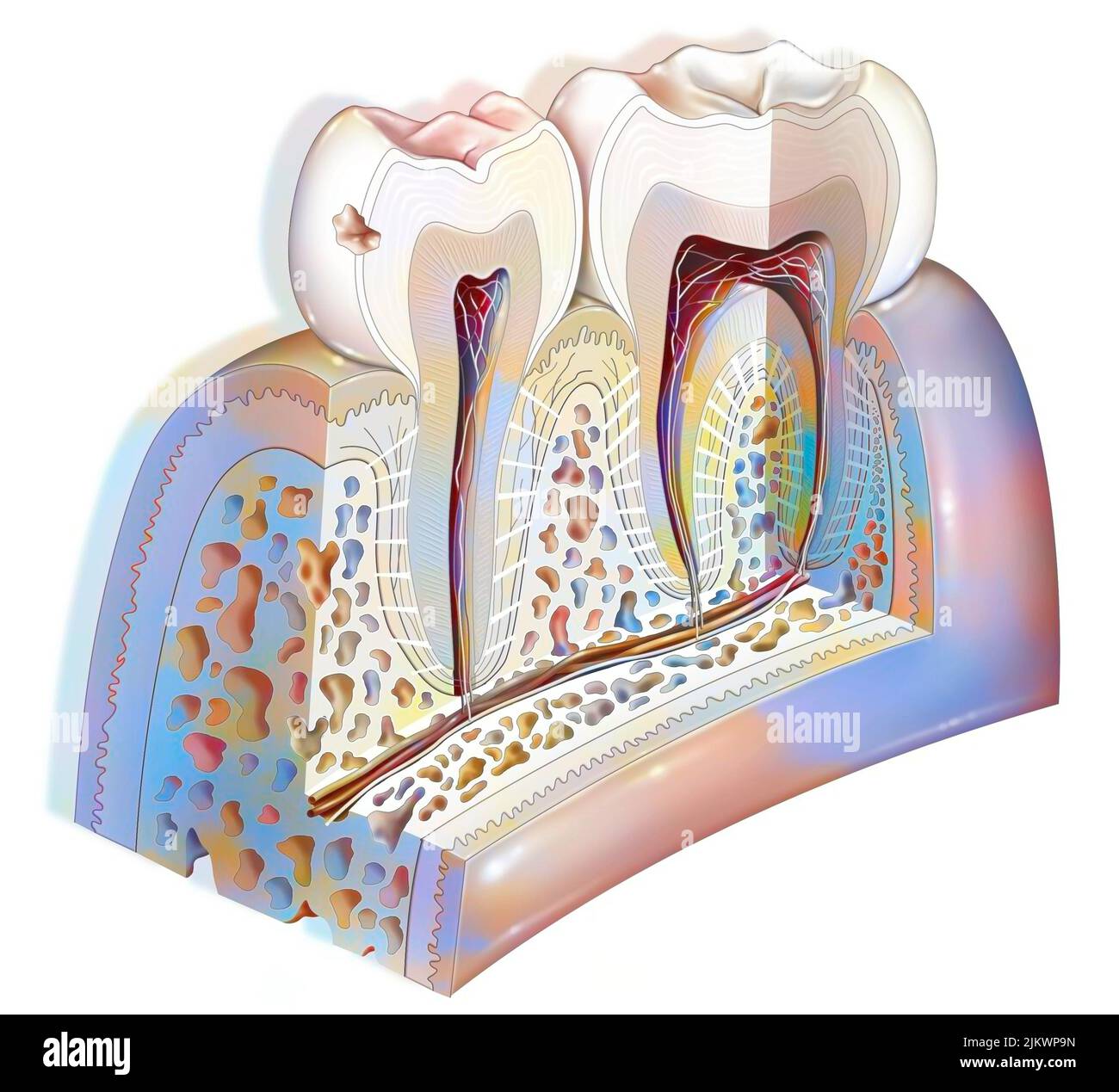 Placca dentale: Prima fase carie dentale. Foto Stock
