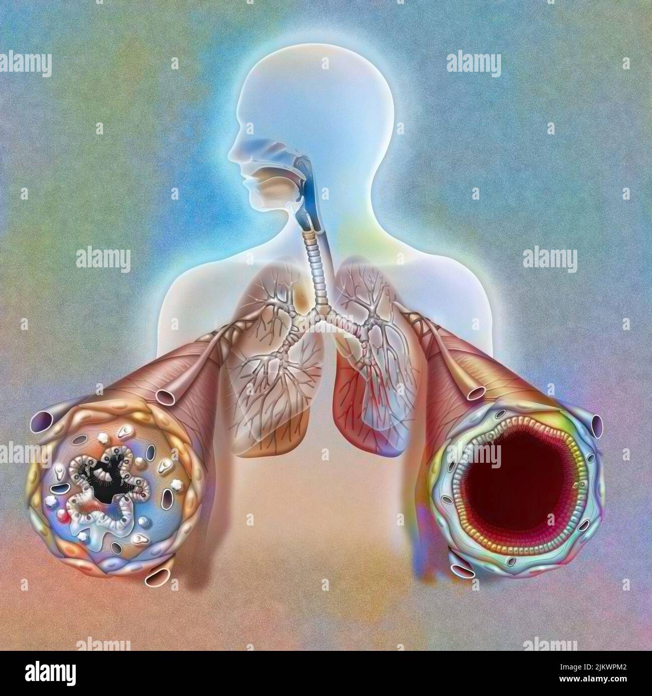 La condizione dei bronchi durante e dopo un attacco di asma. Foto Stock