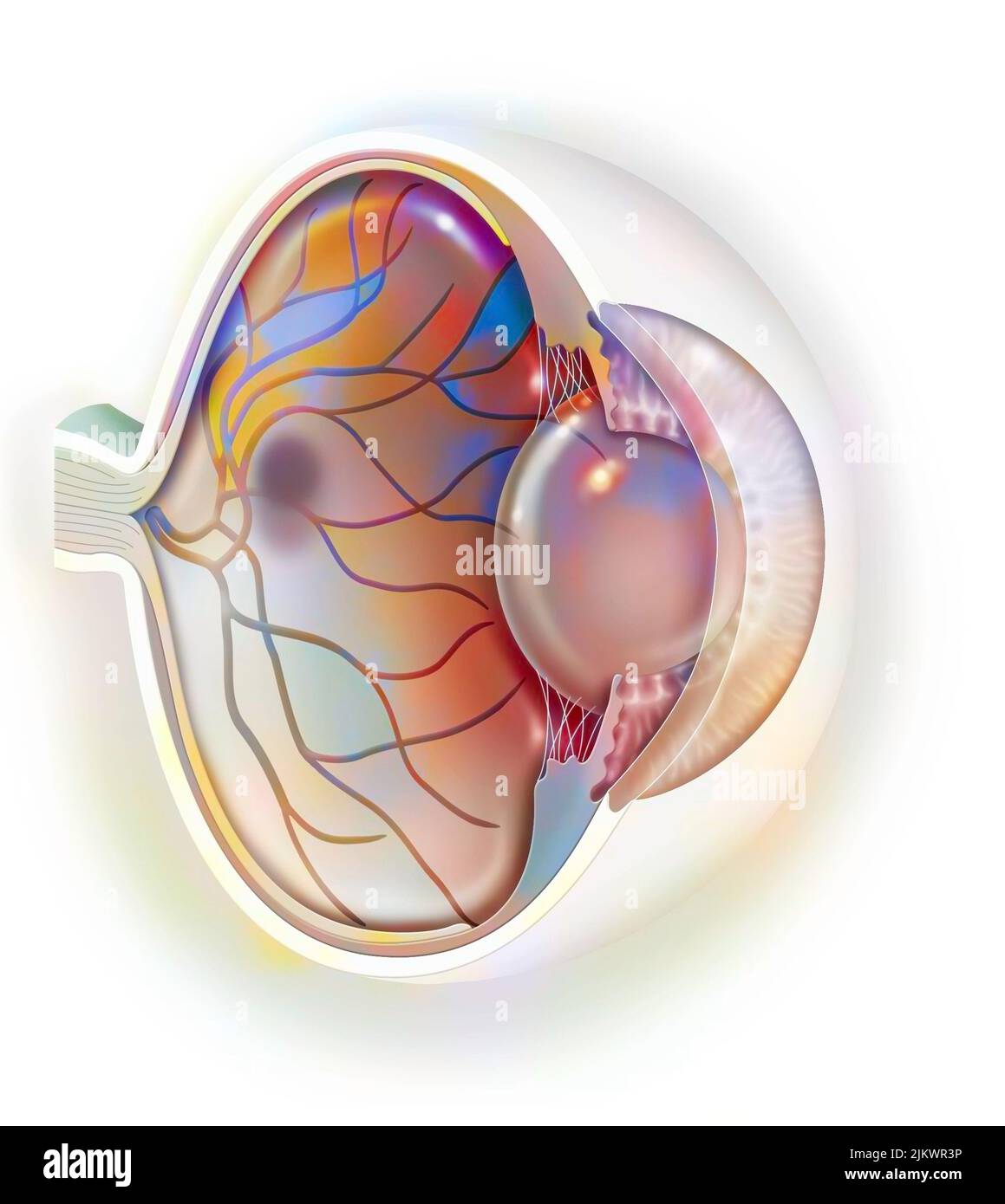 Degenerazione maculare legata all'età che colpisce la macula, la zona centrale della retina. Foto Stock