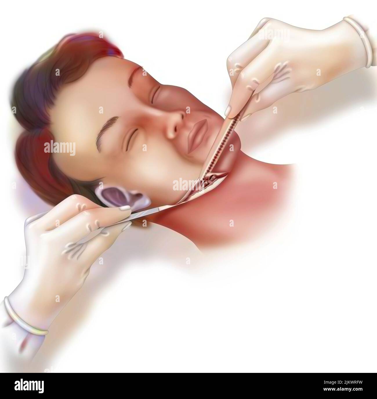 Incisione intorno al collo di un paziente per innestare un altro volto. Foto Stock
