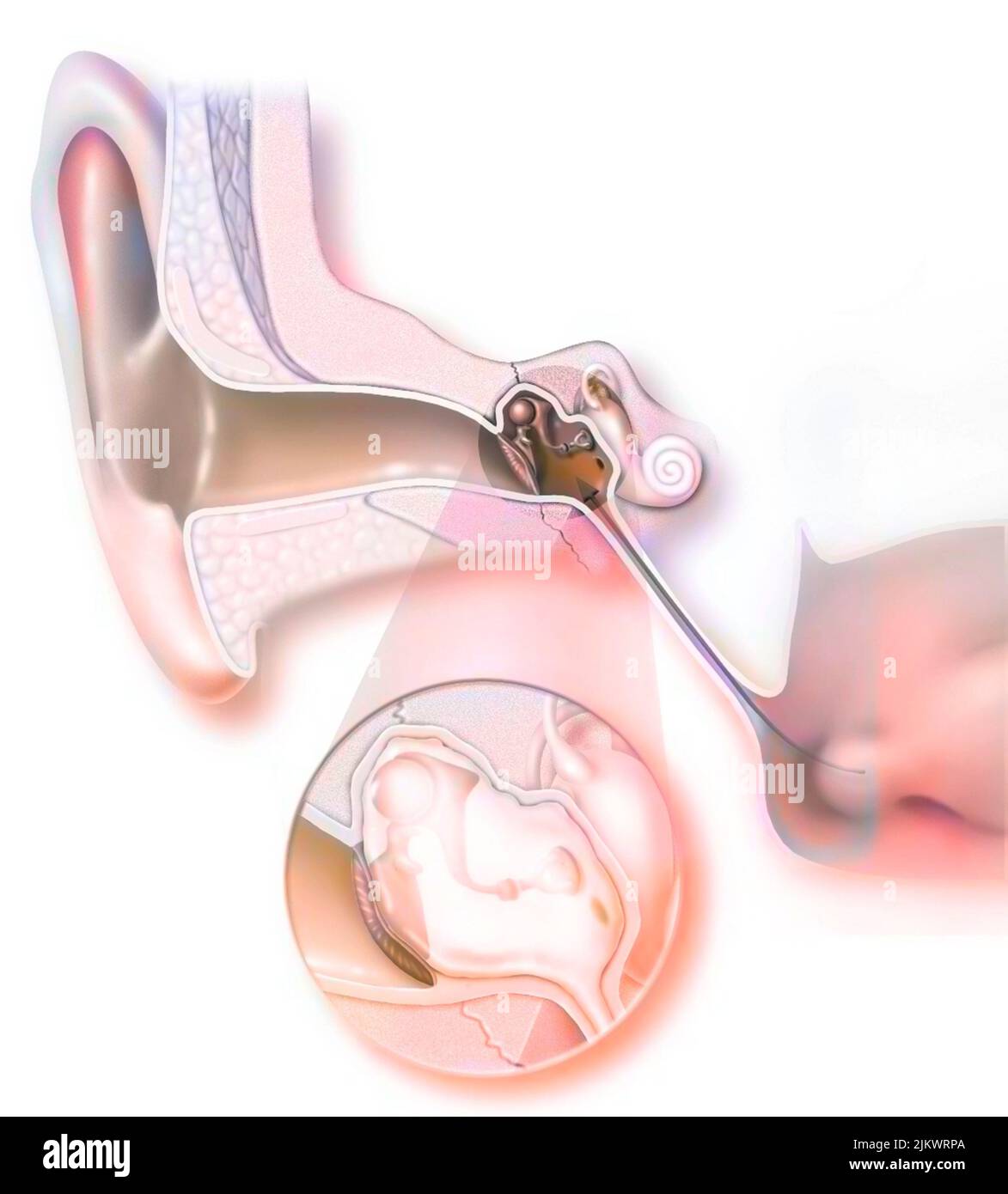 L'otite acuta è un'infiammazione batterica o virale dell'orecchio medio. Foto Stock