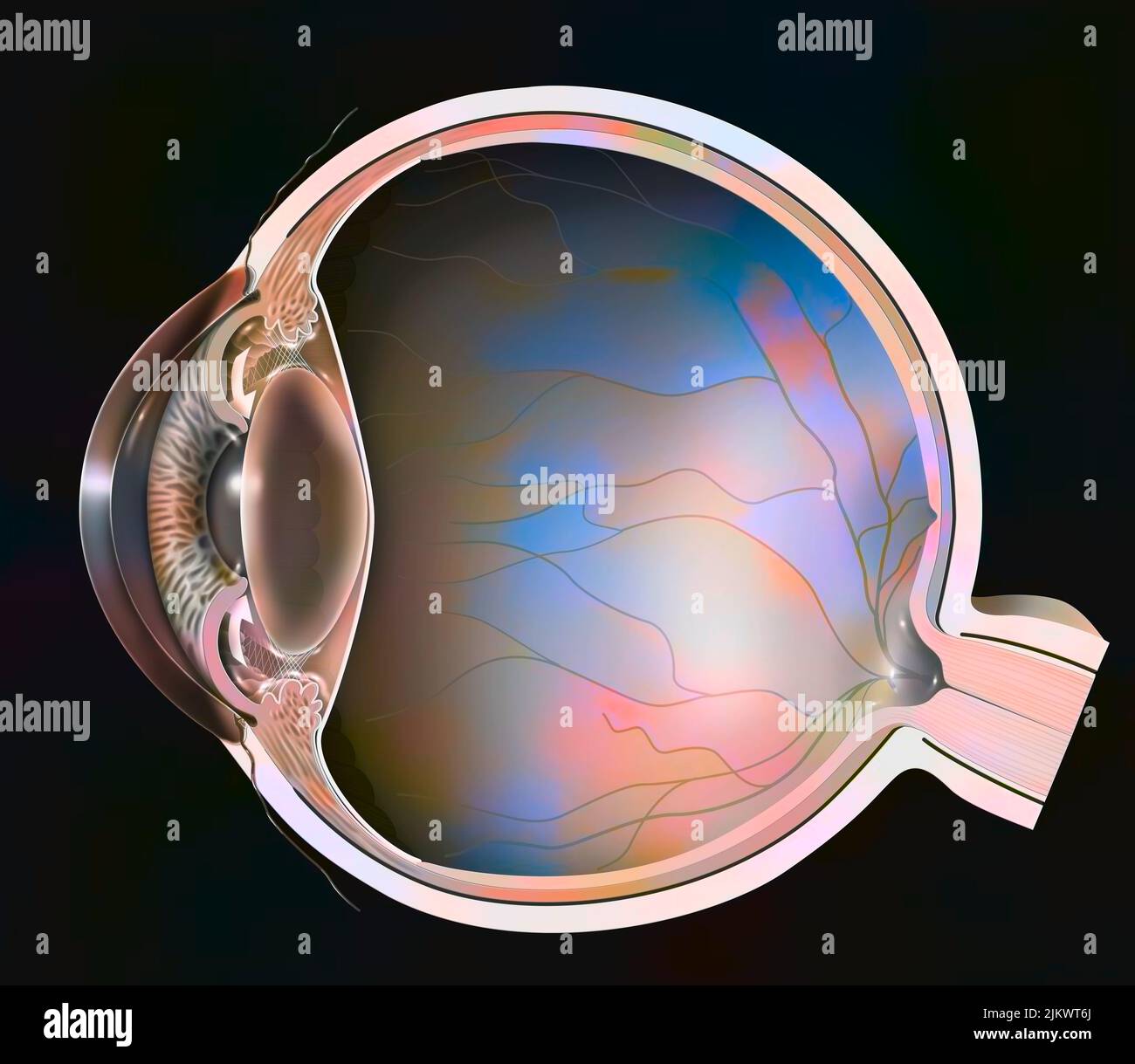 Glaucoma ad angolo chiuso: La trabecola è bloccata a causa della pupilla. Foto Stock