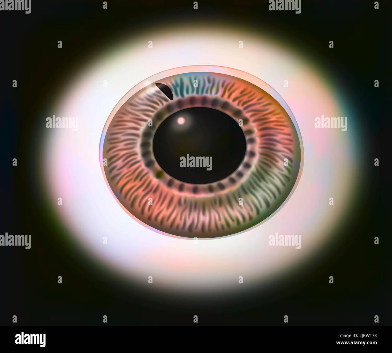 Glaucoma: L'iride di un occhio per mostrare la procedura iridectomia laser. Foto Stock