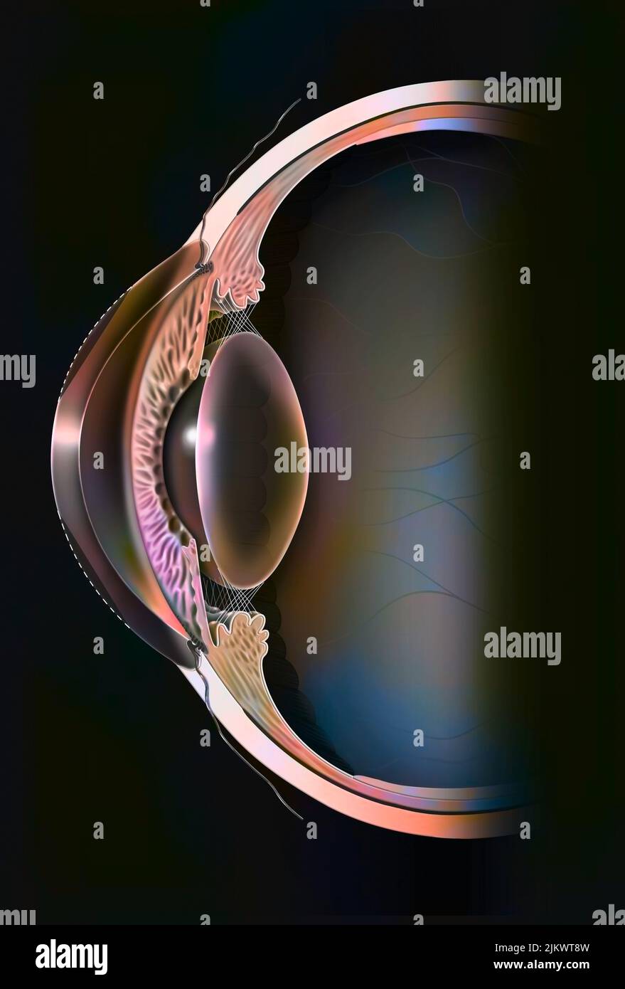 Chirurgia oculare: Fotokeratectomia rifrattiva nel caso di un occhio iperopico. Foto Stock