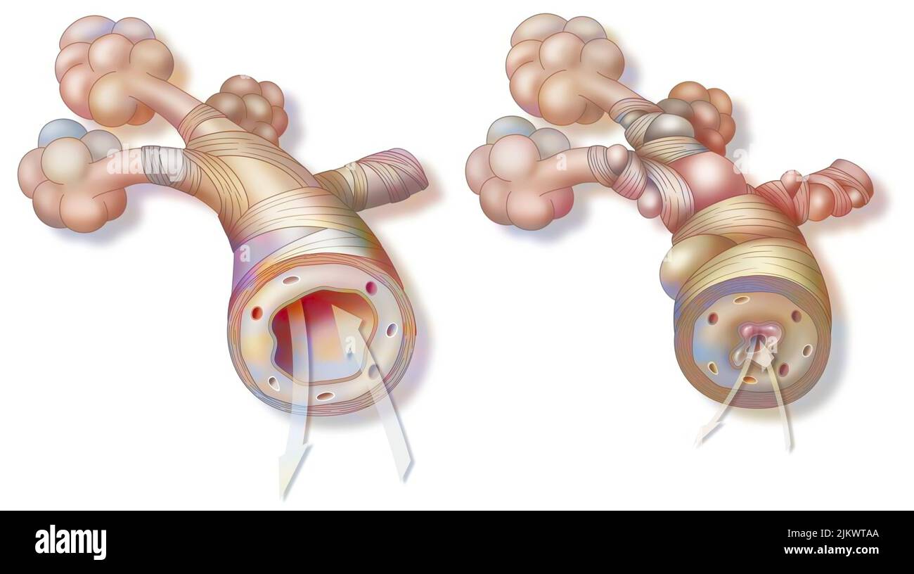 Asma: Bronchiolo sano (a sinistra) e asmatico (a destra). Foto Stock