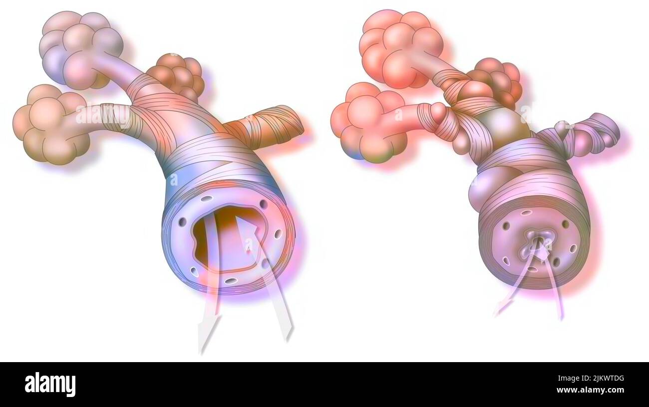 Asma: Bronchiolo sano (a sinistra) e asmatico (a destra). Foto Stock
