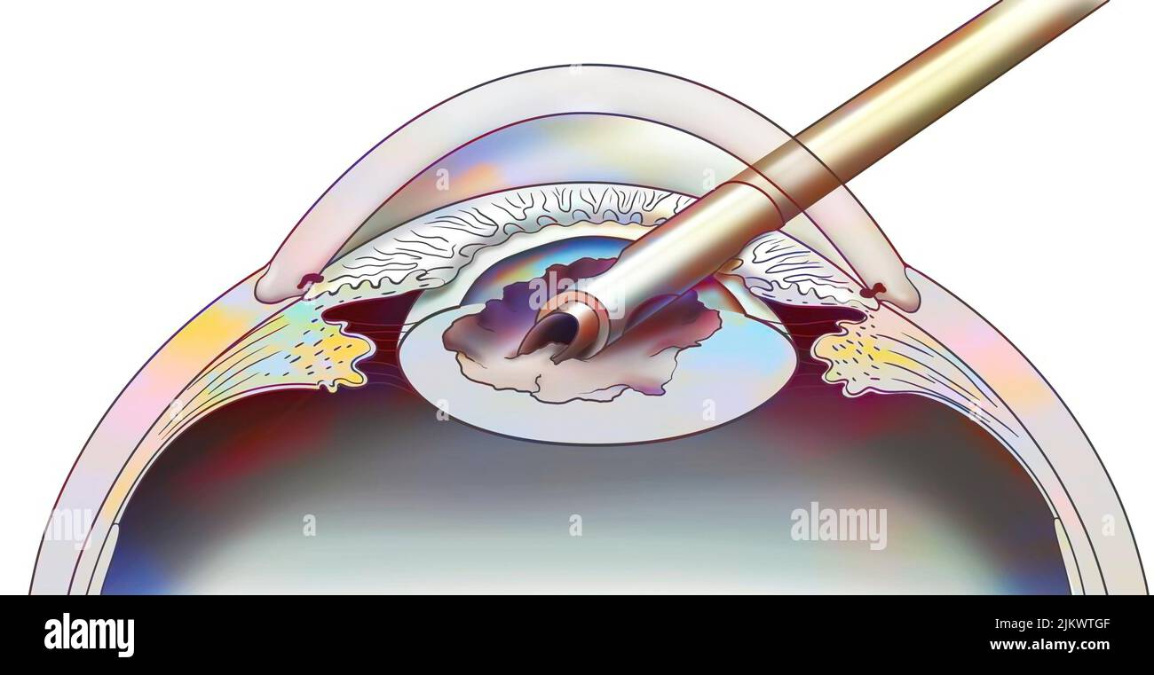 Occhio, cataratta, facoemulsificazione: Consiste nel rompere la lente con una sonda. Foto Stock