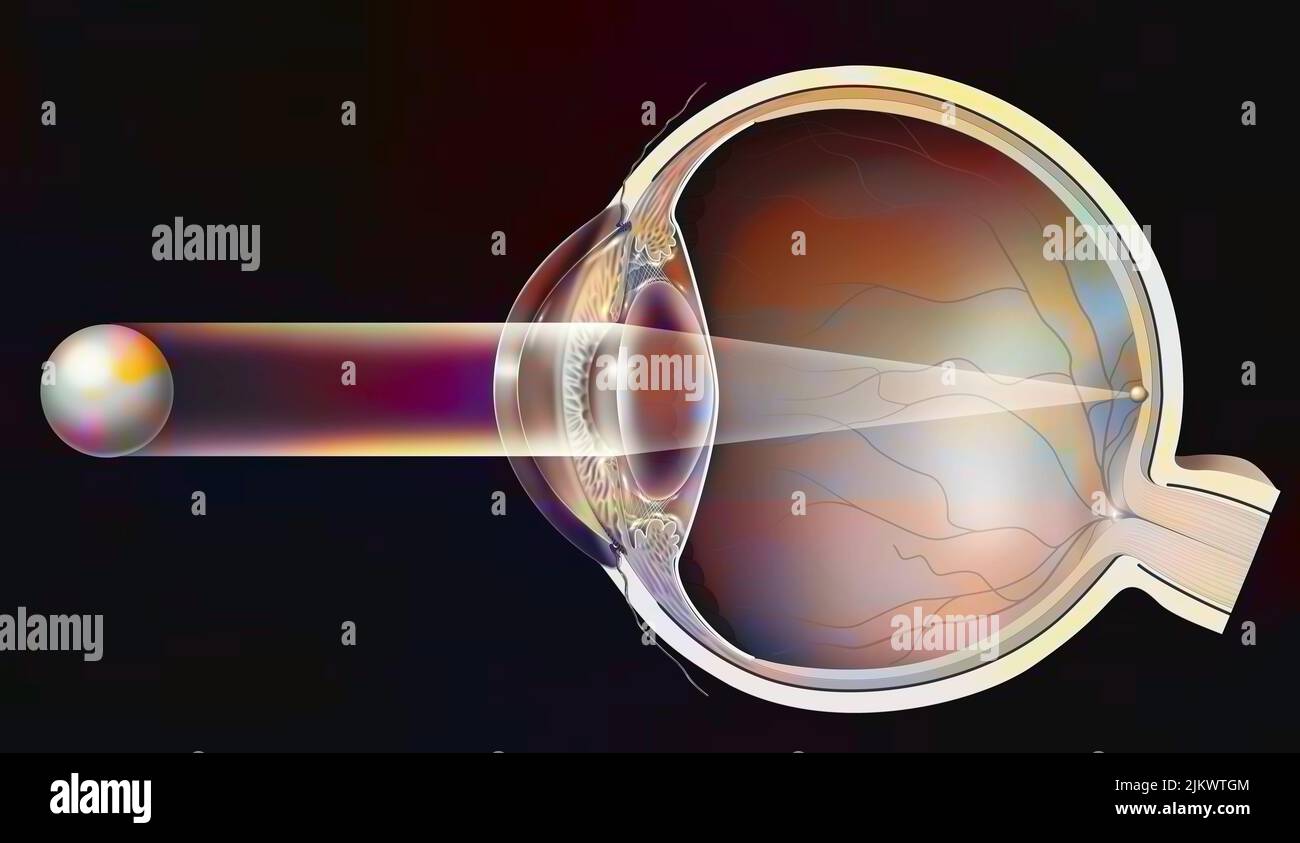 Visione normale in un occhio sano: L'immagine si forma sulla retina. Foto Stock