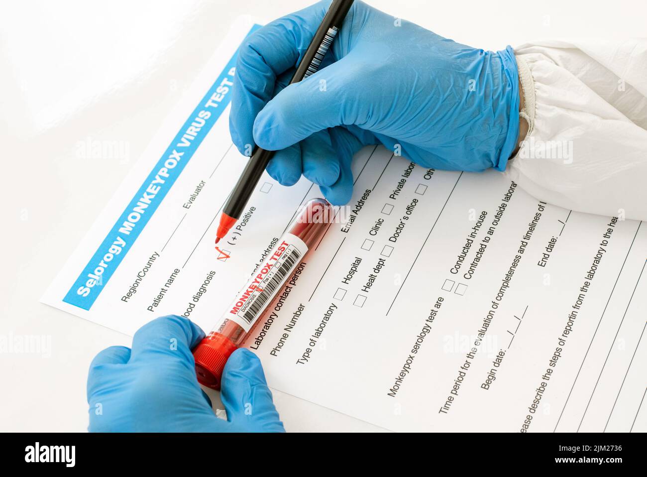 medico di visione aerea con guanti in nitrile riempire il modulo di analisi del sangue per il scimmipox con le mani risultato positivo Foto Stock