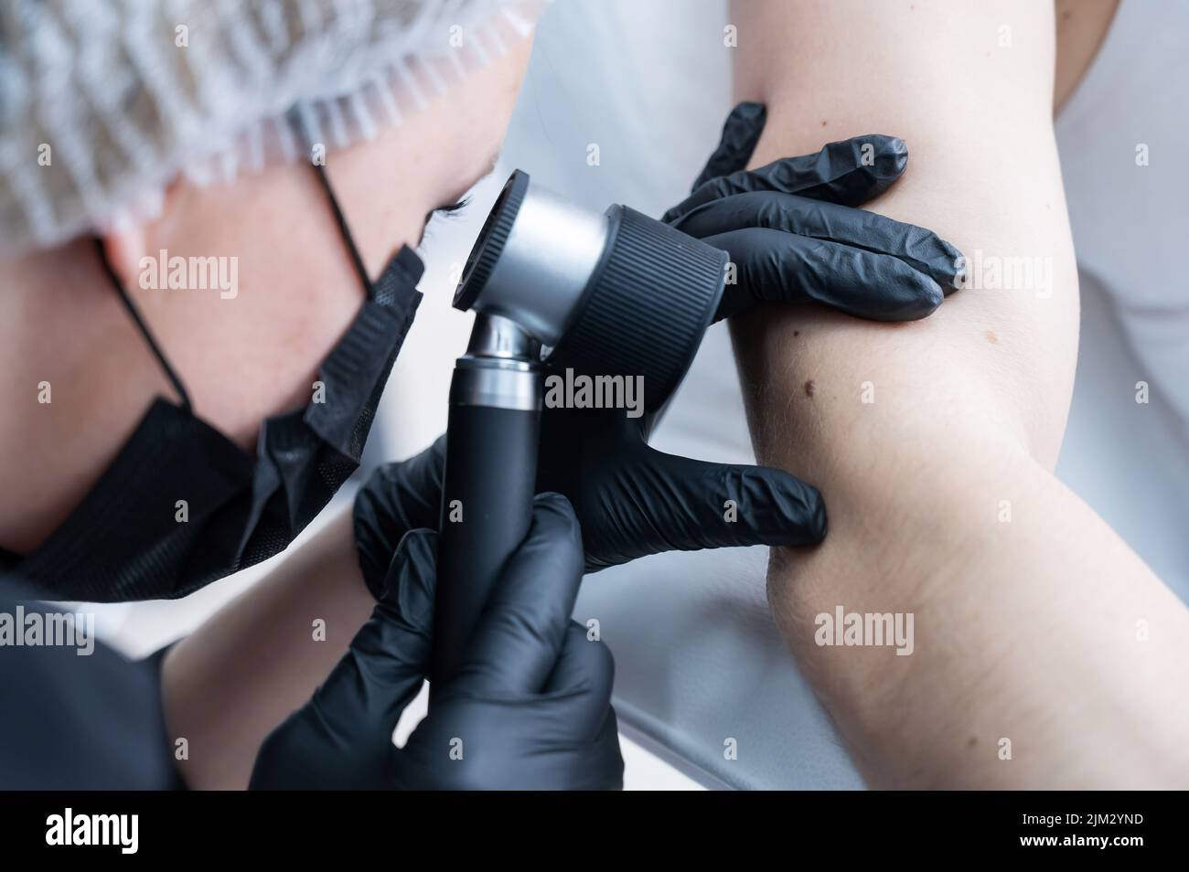 Un dermatologo esamina la talpa di un paziente attraverso un dermatoscopio. Foto Stock