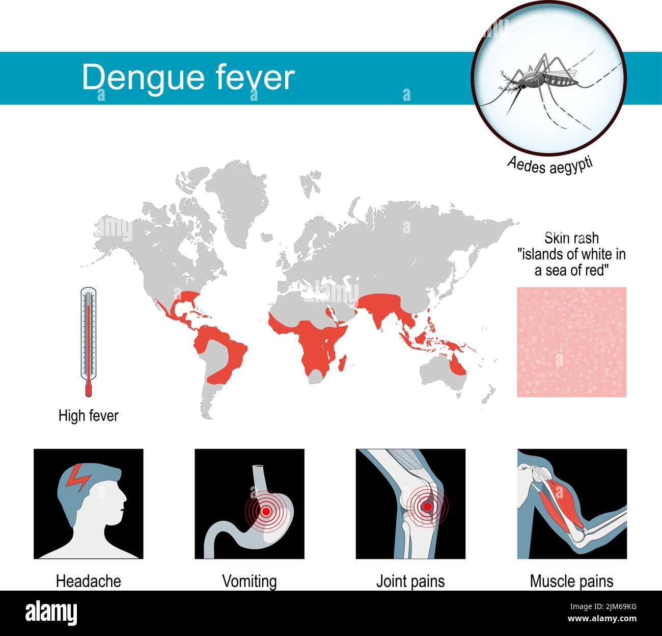 Sintomi di febbre dengue. Poster di infografia e consapevolezza. Mappe di dengue epidemica. Primo piano di Aedes aegypti - zanzara che diffonde la malattia. Vettore Illustrazione Vettoriale