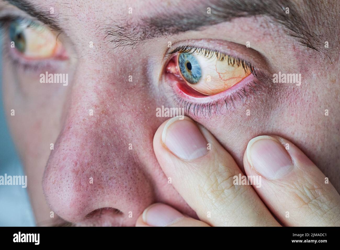 Occhio umano con bulbo oculare giallo, primo piano. Gli occhi gialli sono un sintomo di malattia del fegato o epatite Foto Stock