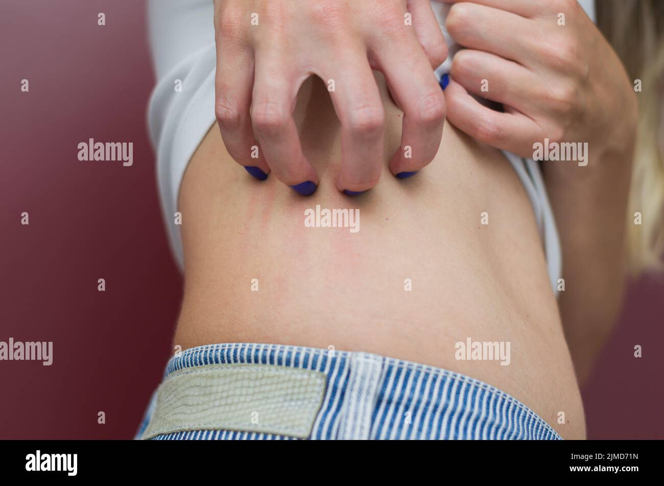 Grande concetto di allergie e malattie della pelle, giovane donna graffiare se stessa. Foto Stock
