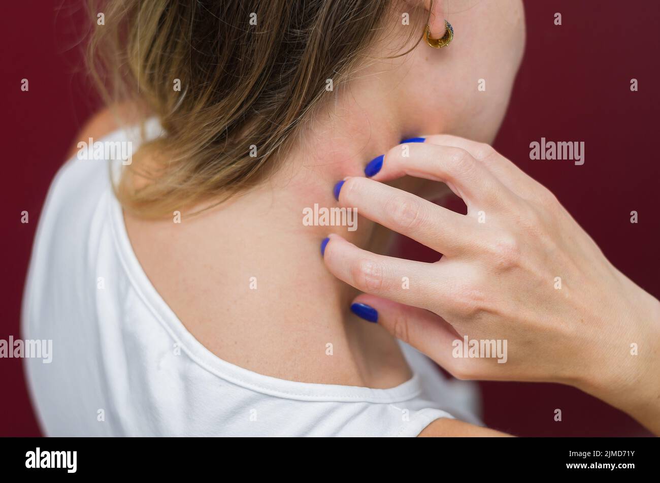 Grande concetto di allergie e malattie della pelle, giovane donna graffiare se stessa. Foto Stock