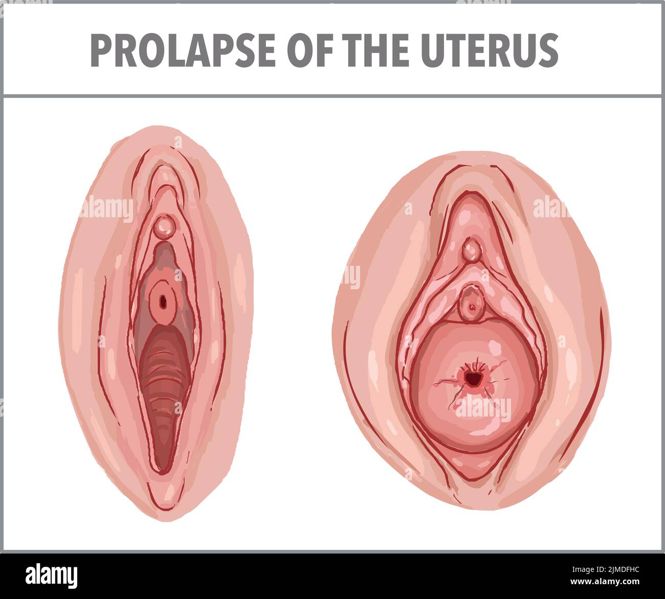 Prolapse of the uterus immagini e fotografie stock ad alta risoluzione -  Alamy